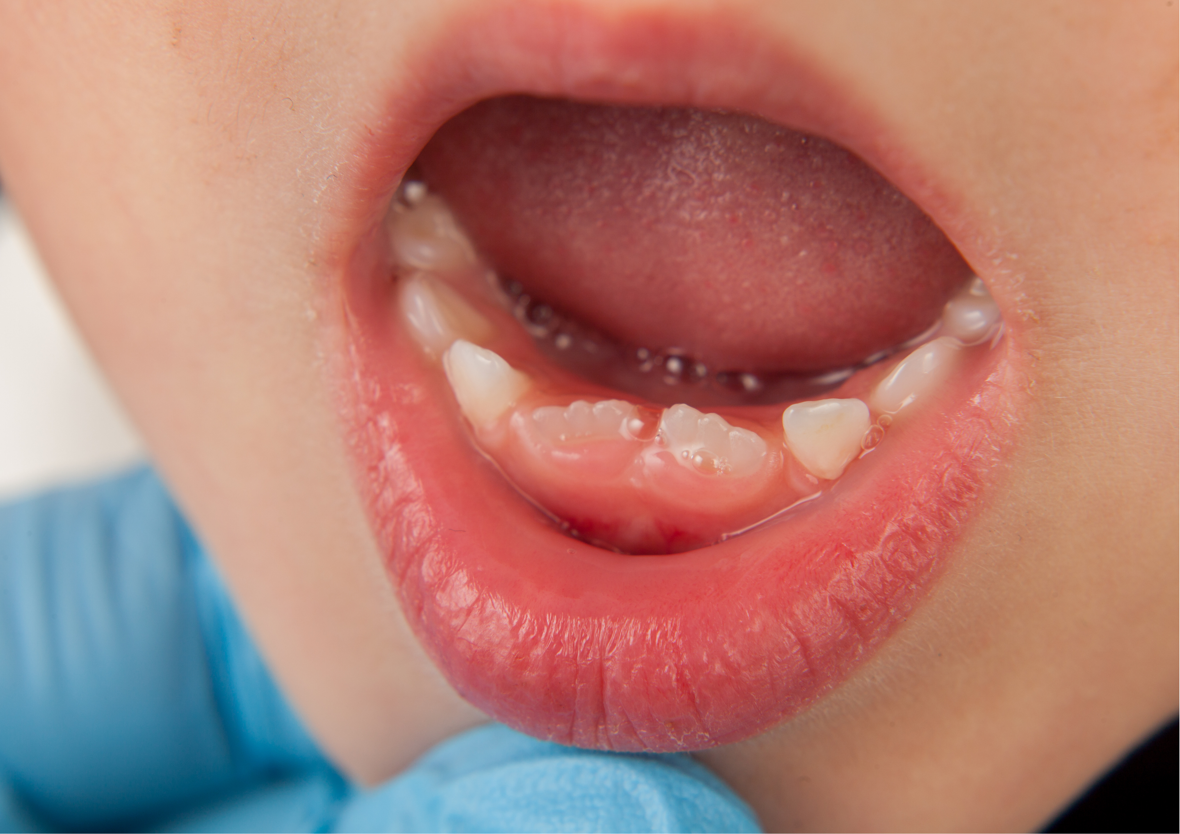 Dentizione e insonnia nei bambini: cosa sapere 