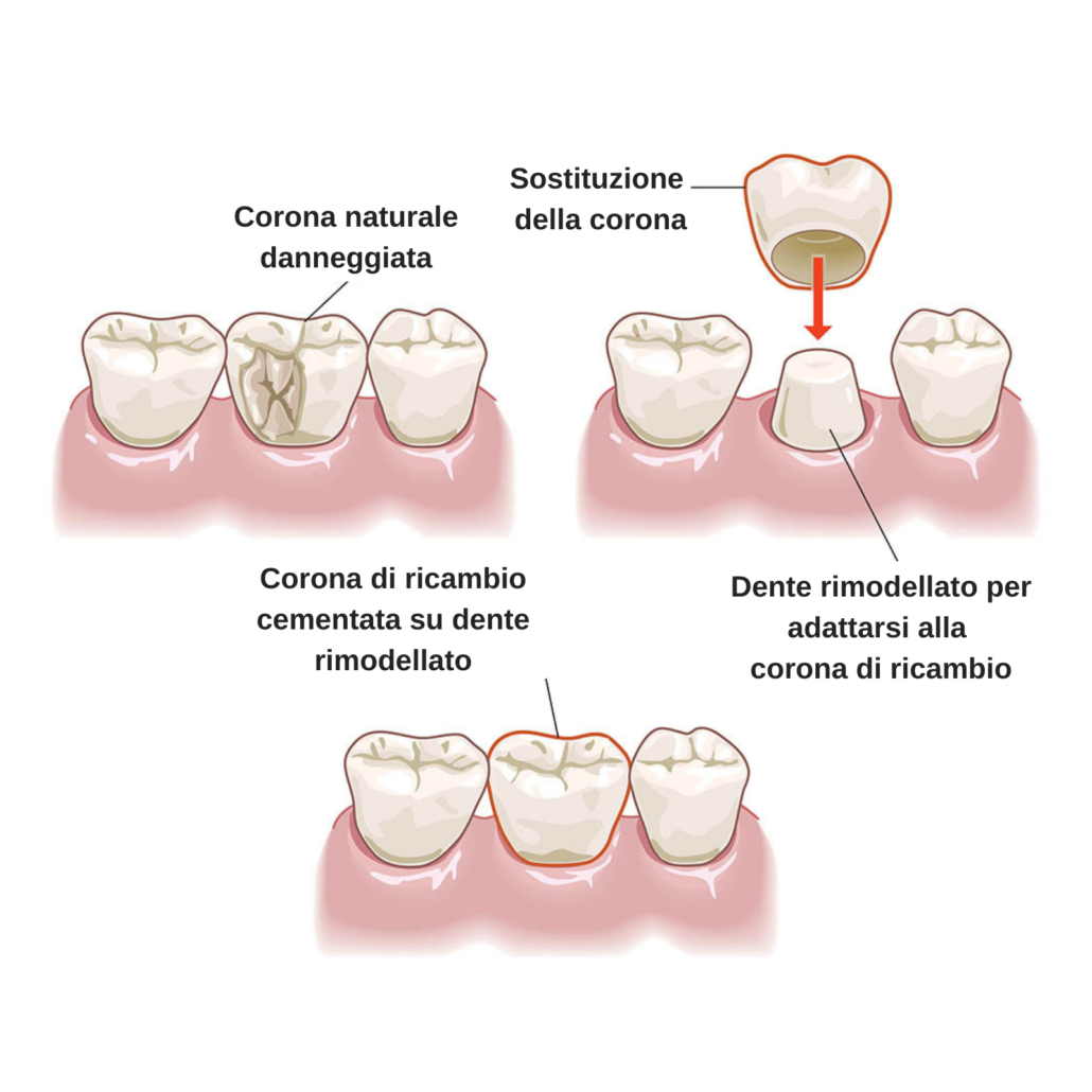 Corona dentale: cos'è, quando si usa e di cosa è fatta